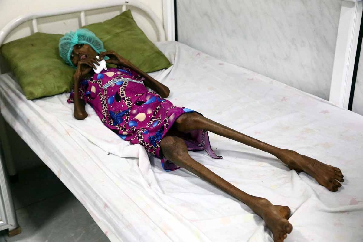 Saida Ahmad Baghili, an 18-year-old Yemeni woman from an impoverished coastal village on the outskirts of the rebel-held Yemeni port city of Hodeida, where malnutrition has hit the population hard, lies in a bed at the al-Thawra hospital in Hodeidah where